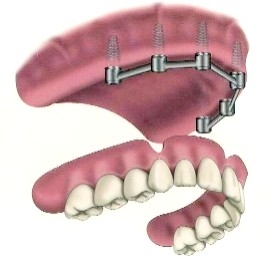 Stabilisation d'une prothèse par une barre sur 4 implants