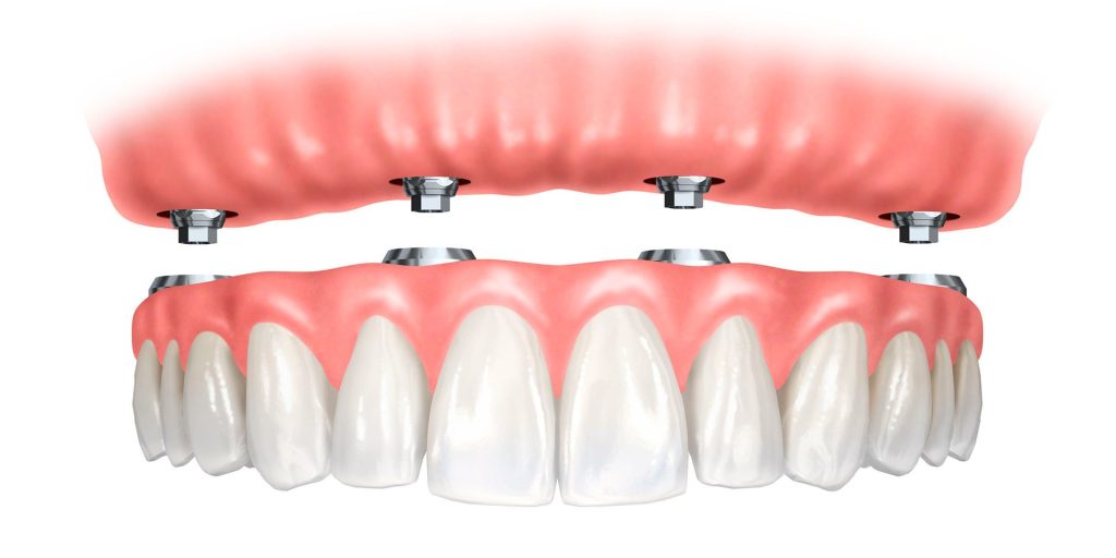 Implant dentaire bouche complete prix - Budapest, Hongrie