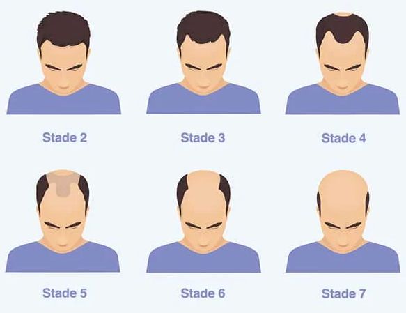 Points à considérer avant une greffe de cheveux - Genève, Suisse