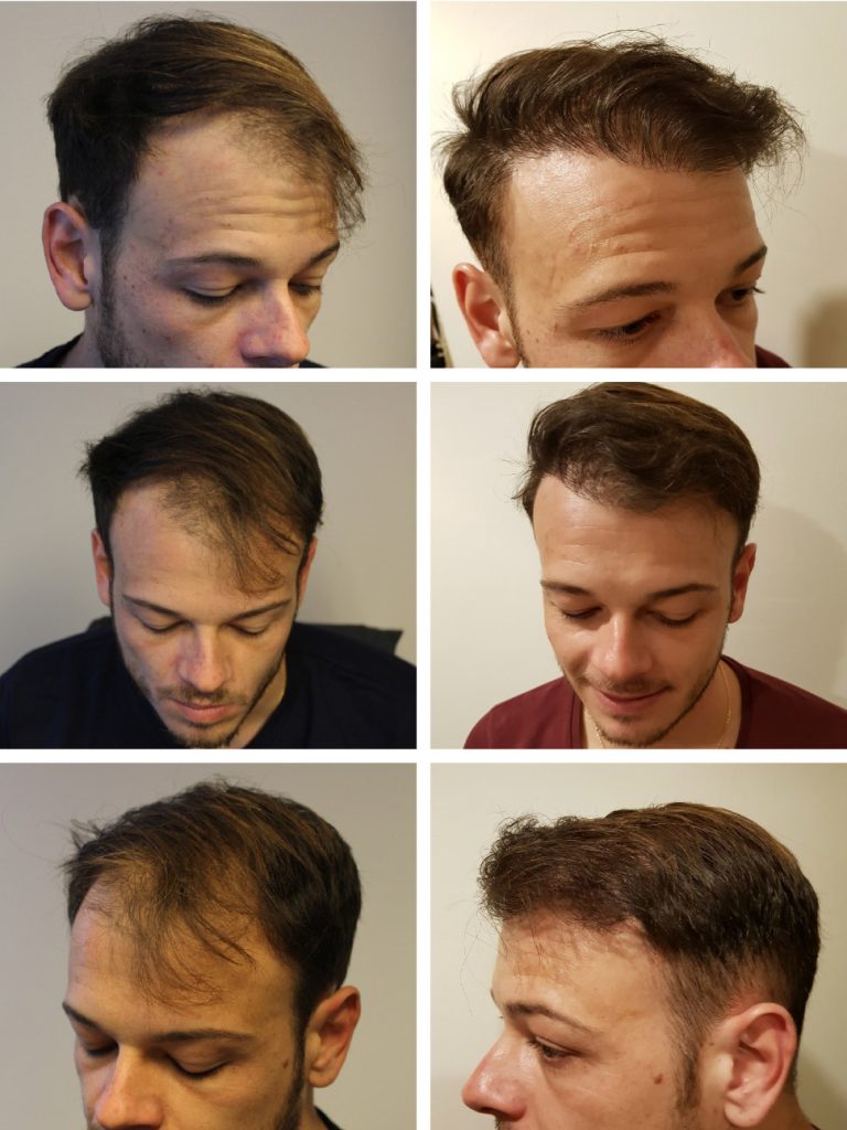 Ce Que Vous Devez Savoir Avant de Subir une Greffe de Cheveux