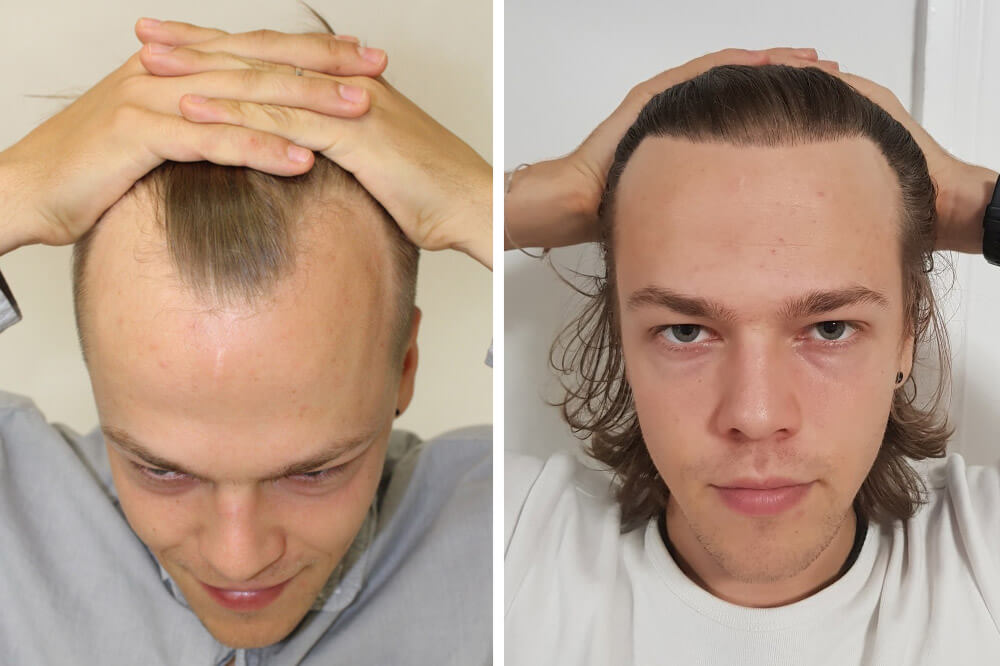 Pensez aux greffes de cheveux si vous avez entre 22 et 35 ans