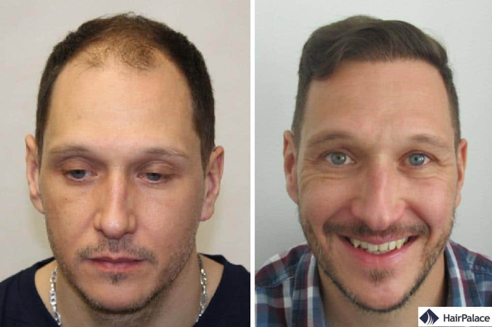 Greffe de cheveux chez les hommes âgés de 35 à 65 ans