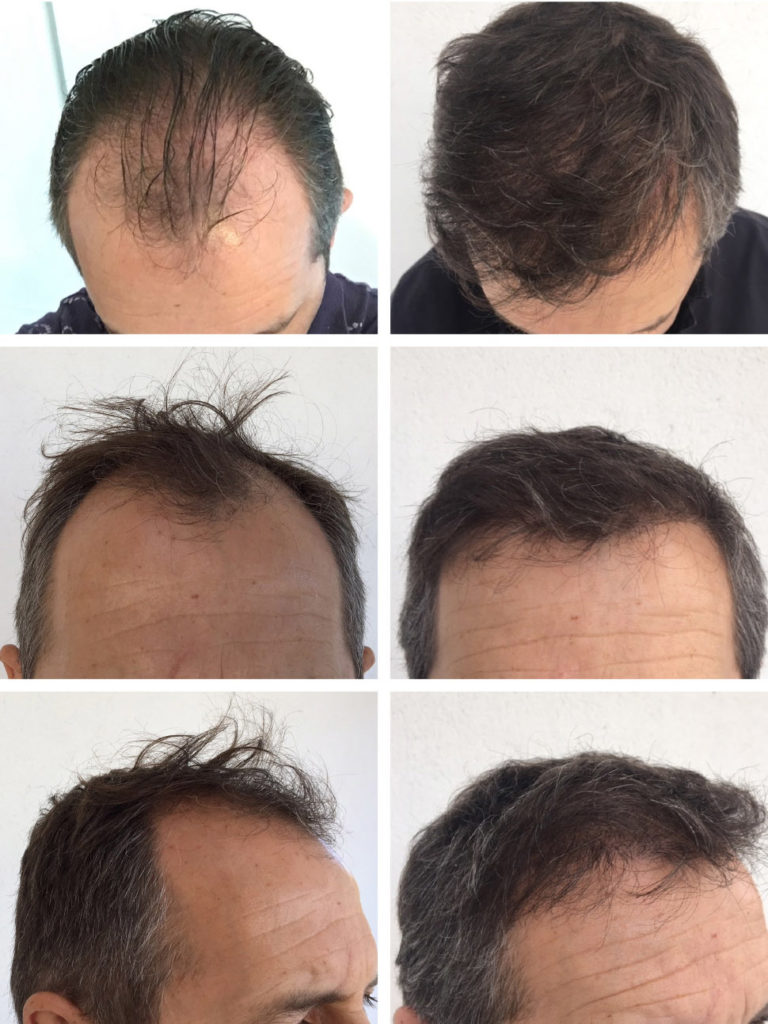 Des Greffes de Cheveux de Haute Qualité à un Prix Abordable