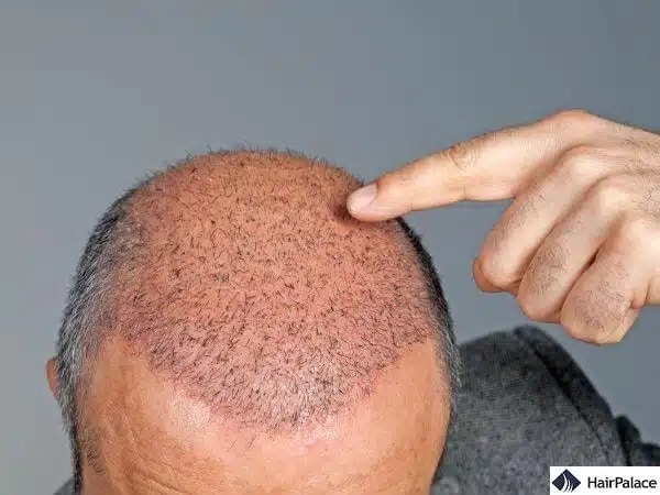 La greffe de cheveux, le nouveau mode de chirurgie esthétique