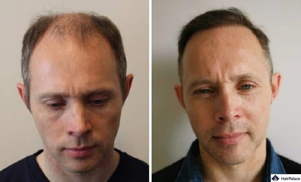 pourquoi je veux une greffe de cheveux ?
