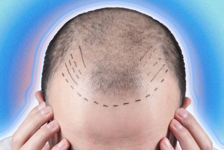Les sales petits secrets des greffes de cheveux 