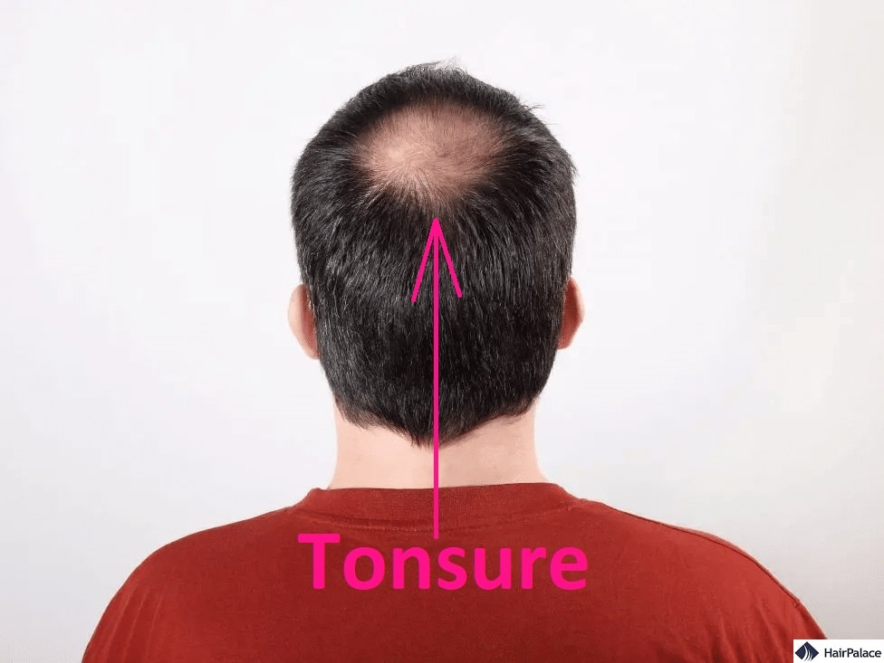 Greffe de cheveux - Solution pour calvitie frontale et vertex