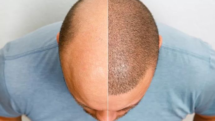 Greffe de cheveux : Pièges à éviter, coût, risques, efficacité...