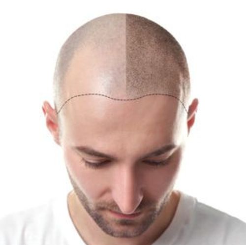 Pourquoi se faire greffer des cheveux en Turquie